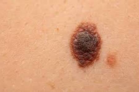 Argentina desarrolló la primera vacuna terapéutica con el melanoma 