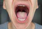 ¿Qué es el cáncer bucodental y cómo se origina?
